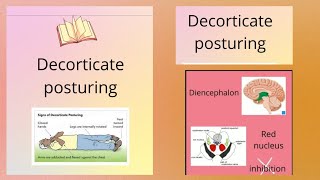 DECORTICATE POSTURE Abnormal posturing [upl. by Sitof]