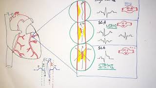 les biomarqueurs cardiaques [upl. by Rosecan]