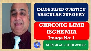 CHRONIC LIMB ISCHEMIA  Intermittent Claudication  VASCULAR SURGERY Image Based Question [upl. by Ronyam]