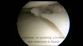 Knee Meniscal Tear Treatment  Keyhole Surgery Arthroscopy [upl. by Zampino]