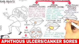 Aphthous ulcer stomatitis Canker sore treatment [upl. by Kcirrad]