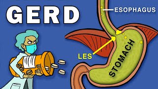 Gastroesophageal Reflux Disease GERD [upl. by Ettenay]