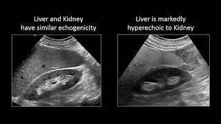 GI Imaging  Hepatic Steatosis and Cirrhosis [upl. by Petersen]