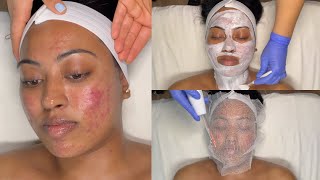 CYSTIC ACNE TREATMENT  WALKIN FACIAL FOR GRADE 3 AND 4 ACNE WITH PRO TIPS  LICENSED ESTHETICIAN [upl. by Panthia318]