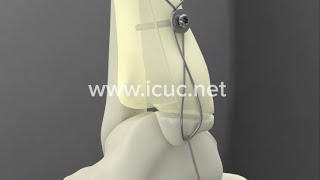 Medial Malleolus ORIF  ICUC® Video [upl. by Tnecillim]