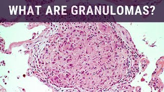 What are Granulomas  Pathology mini tutorial [upl. by Zoe]