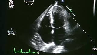 Atrial Rhythms  EKG Interpretation  LevelUpRN [upl. by Akeemaj]