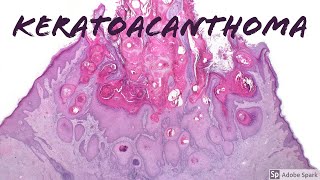 Keratoacanthoma cancer or not [upl. by Miarfe135]