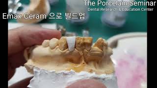 무삭제 메릴랜드 지르코니아 브릿지 Nonprep Maryland bridge Zirconia [upl. by Stoffel]