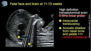 Hi9  How many Scans to do During Pregnancy   Dr Chinmayee Ratha  Fetal Specialist [upl. by Truscott]