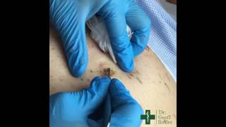 Removal of Seborrheic Keratosis [upl. by Onairpic]