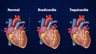 Doenças do Coração  Arritmia Cardíaca [upl. by Sidnarb]