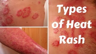 Types of Heat Rash [upl. by Langelo]