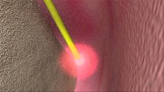 Laser Periodontal Therapy  WPT™ Animation [upl. by Ytsur]