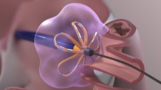 Medical Device Animation Atrial Fibrillation Ablation Surgery [upl. by Hines305]