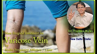 Latest Varicose Vein Treatment [upl. by Dnalyag]