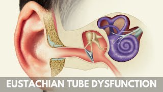 What is Eustachian Tube Dysfunction [upl. by Eirrab]