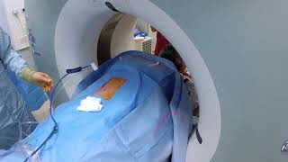 Renal tumour microwave ablation under CT guidance [upl. by Aivitnahs]