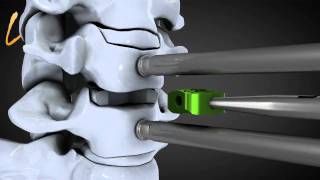 Hernie discale cervicale  Spinal disk herniation  Kisco International [upl. by Leoy]