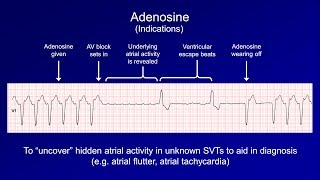 Antiarrhythmics Lesson 6  Digoxin Adenosine Atropine Isoproterenol and Ivabradine [upl. by Nylsirhc]