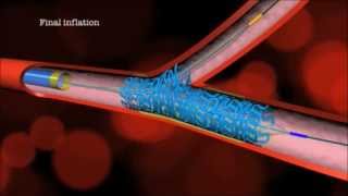 Main Branch Bifurcation Stent quotPROVISIONALquot by Advanced Bifurcation Systems [upl. by Sama]