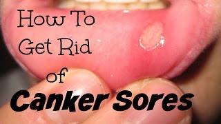 How To Get Rid Of A Canker Sore In 2 HoursEasy Trick [upl. by Blackman851]