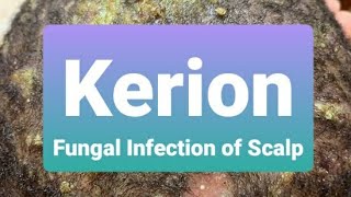 Kerion  Insight and Treatment [upl. by Arel]