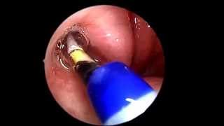 Eustachian Tube Balloon Dilation [upl. by Barnum]