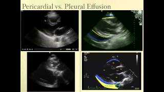 Pericardial Effusion Ultrasound Review [upl. by Blackstock]