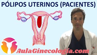 PÓLIPOS UTERINOS PACIENTES Síntomas diagnóstico y tratamiento  Ginecología y Obstetricia [upl. by Aileno]