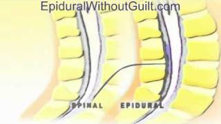 5 Things to Know About Epidural Steroid Injections 602 5076550 [upl. by Jestude781]