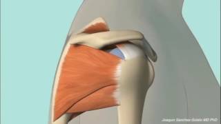 Chronic Subacromial Impingement Animation [upl. by Willard]