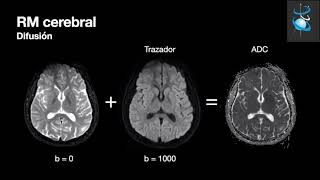 Angiografia cerebral normal Dr Angel Ferrario [upl. by Olraced]