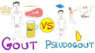 Gout vs Pseudogout  MSU vs CPPD disease  Rheumatology Series [upl. by Ark]