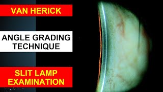 Van Herick Slit Lamp Technique  Angle Grading Technique  Anterior Chamber Angle Test [upl. by Koran]