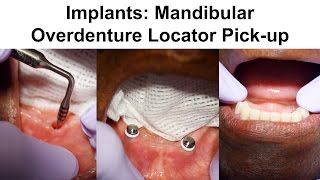 2 Implants Mandibular Overdenture Locator Pickup [upl. by Oiliruam]