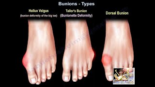 Common Toe Problems and Solutions [upl. by Nelyahs]