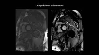 How to assess myocarditis with the help of cardiac MRI CMR [upl. by Yenetruoc]