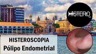 Histeroscopia Cirúrgica para Polipectomia  Pólipo Endometrial [upl. by Niabi]