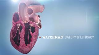 WATCHMAN™ Implant Animation [upl. by Ynaitirb]