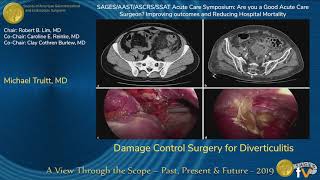 Diverticulosis and diverticulitis Simplified [upl. by Benia]