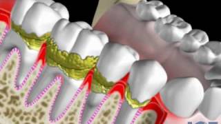 Gum Disease [upl. by Elsbeth]