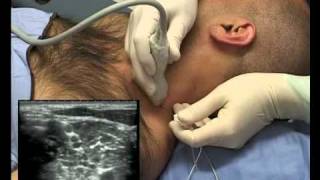 Interscalene Block ultrasound guided  in plane [upl. by Ainnat]