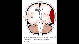 Herniation Syndromes  Cingulate subfalcine Transtentorial Uncal amp Cerebellar Tonsillar [upl. by Mieka]