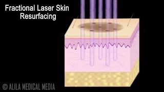 Traditional versus Fractional Laser Skin Resurfacing Procedure Animation [upl. by Si]