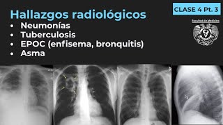 043  Neumonía TB EPOC Enfisema Bronquitis Bronquiectasias Asma [upl. by Aleil]