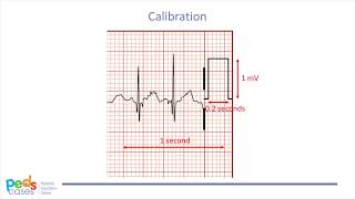 Approach to Pediatric ECGs Part 12 [upl. by Kilan]