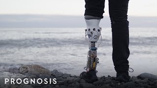 This MIT Engineer Built His Own Bionic Leg [upl. by Belayneh390]