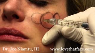 Juverderm Voluma 5 Minute Cheeks by Dr Joe Niamtu III [upl. by Rettuc]