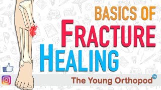 Fracture Healing  ANIMATION  BASICS  The Young Orthopod [upl. by Annibo]